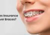 Can Insurance Cover Braces