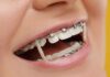 How Much Do Braces Cost Without Insurance