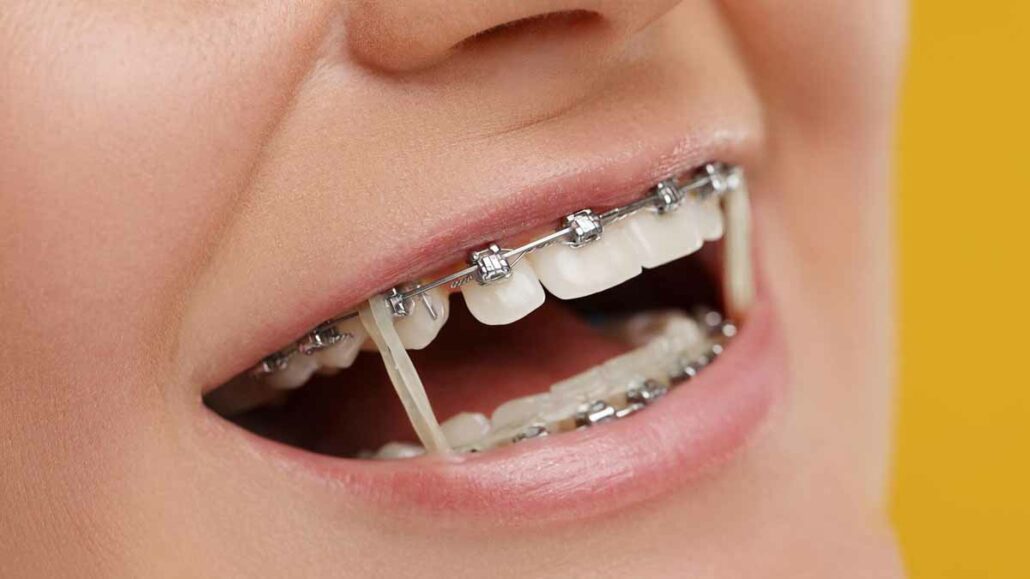 How Much Do Braces Cost Without Insurance