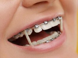 How Much Do Braces Cost Without Insurance
