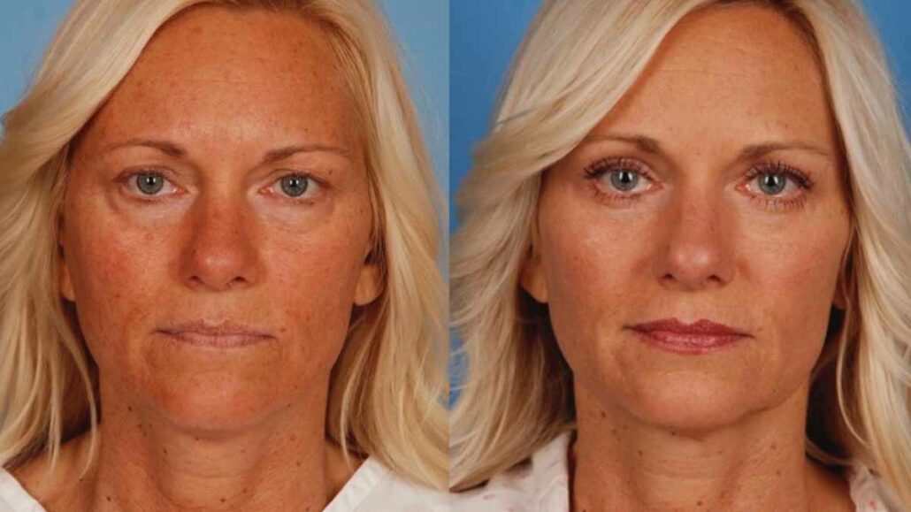 How to Get Insurance to Pay for Eyelid Surgery​