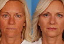 How to Get Insurance to Pay for Eyelid Surgery​